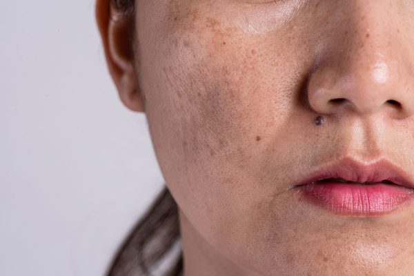 woman-with-problematic-skin-acne-scars-problem-skincare-concept.jpg